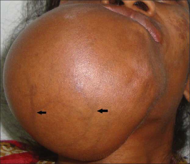 38-year-old female patient with a huge swelling on the right side of the face diagnosed with calcifying epithelial odontogenic tumor. Inferior profile view shows numerous tortuous veins (black arrows) owing to the stretching of the skin overlying the huge swelling.